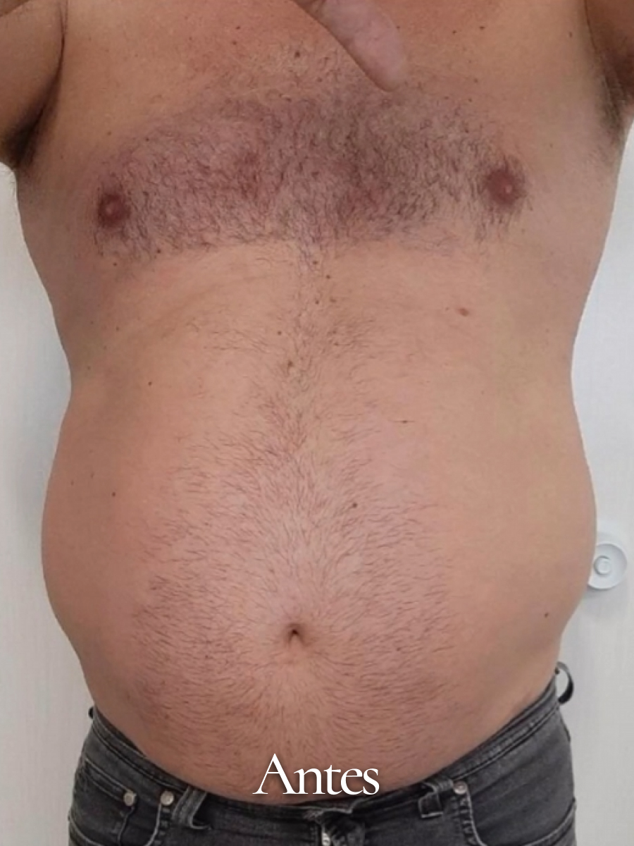 Antes do procedimento 30
