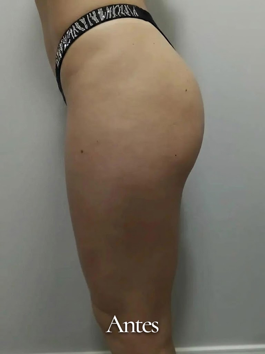 Antes do procedimento 42