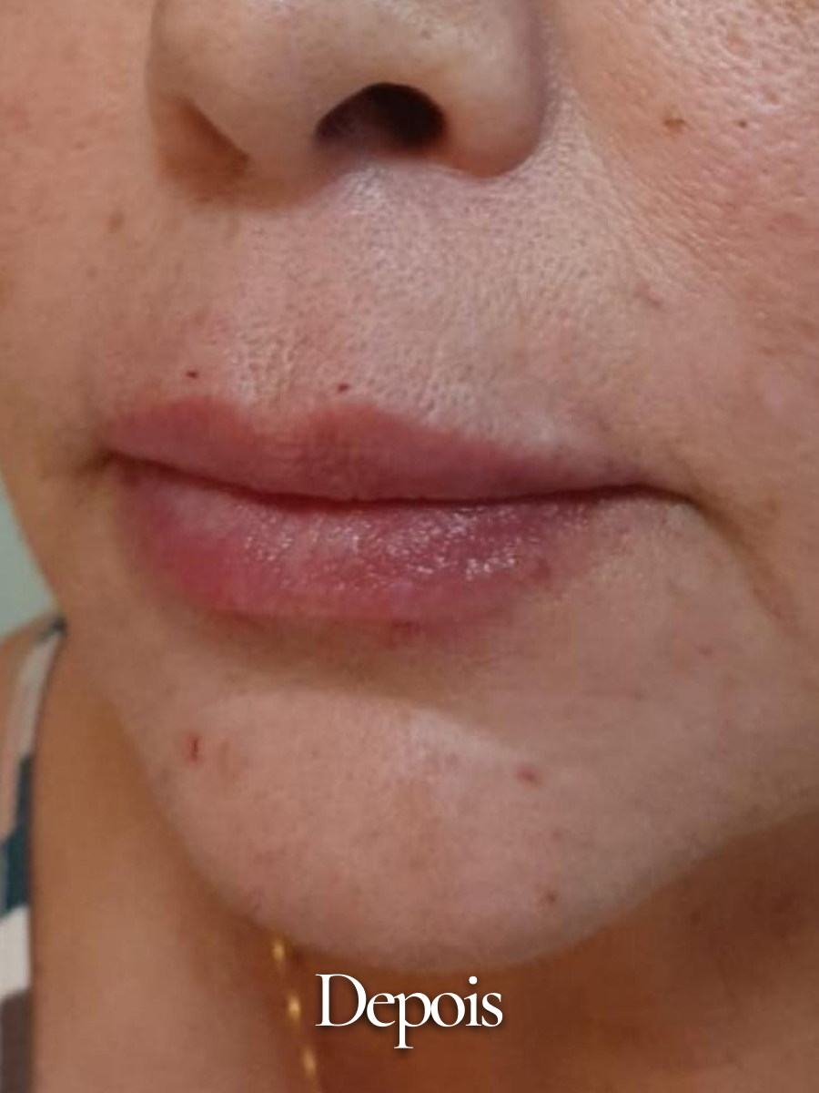 Depois do procedimento 17