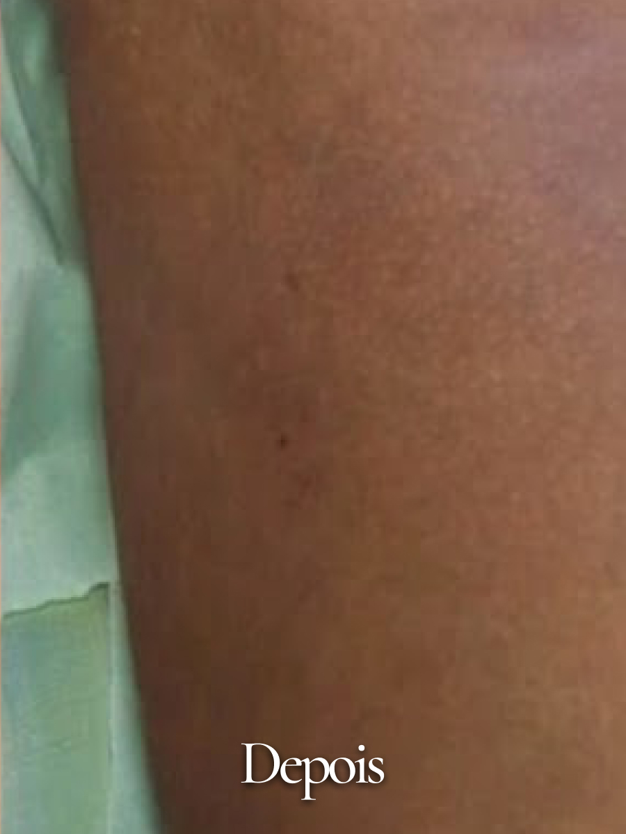 Depois do procedimento 23