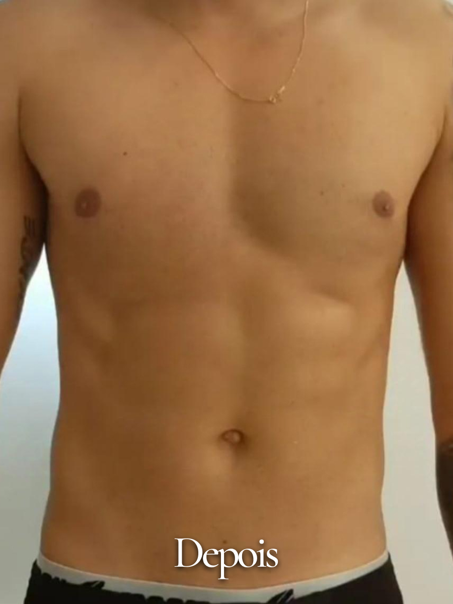 Depois do procedimento 28