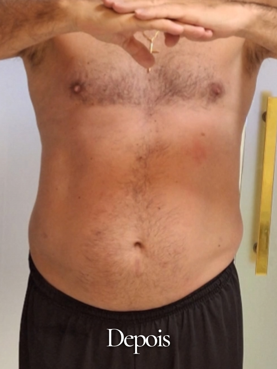 Depois do procedimento 30