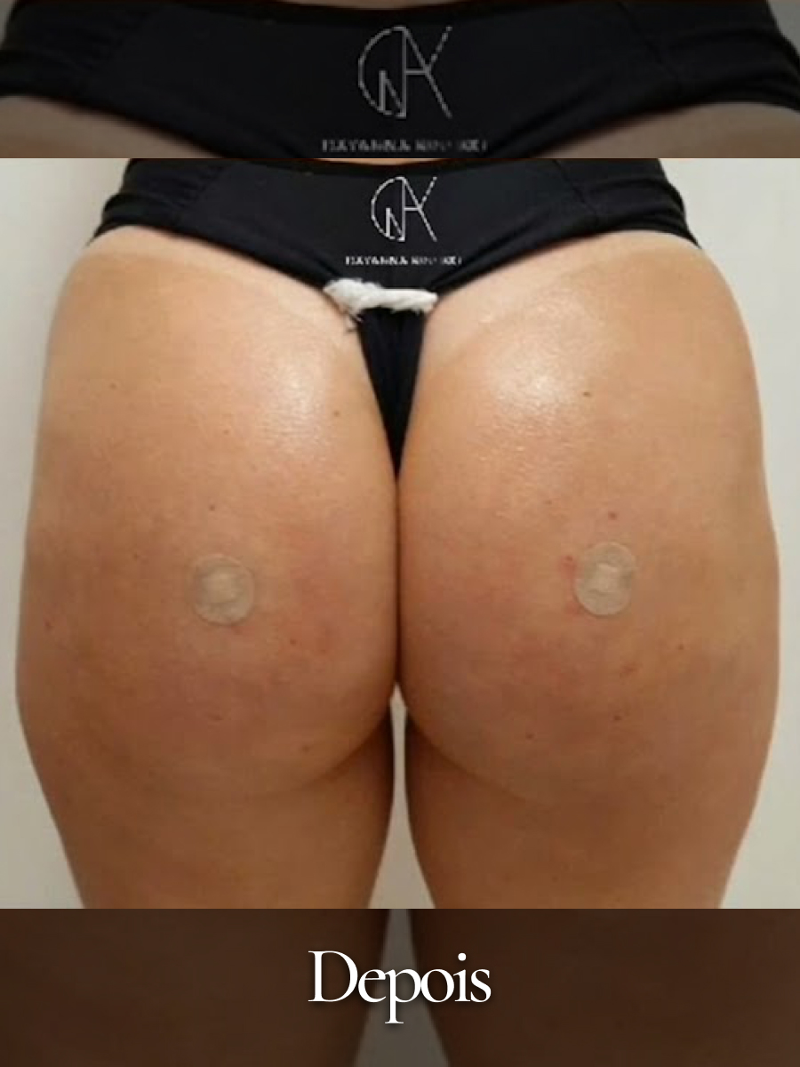 Depois do procedimento 34